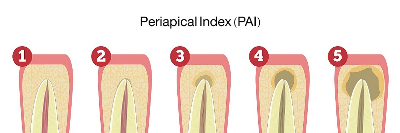 Purpose Of The Periapical Radiograph