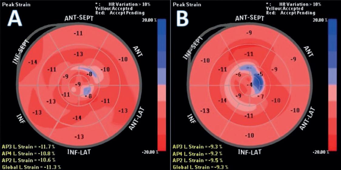 Apical Longitudinal Strain Can Help Predict the Development of Left ...