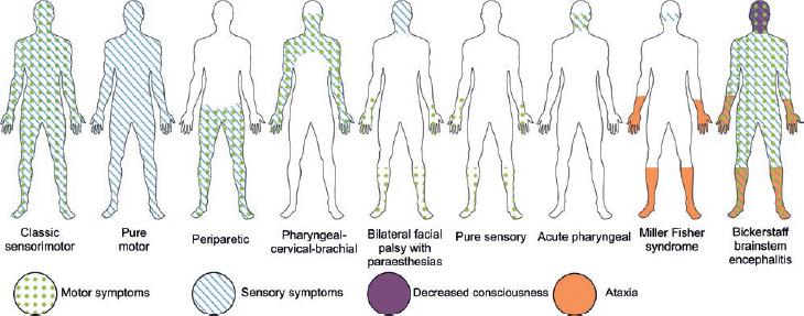 Guillain-Barré Syndrome in Mexico: An Updated Review Amid the ...