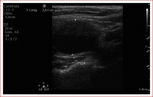 A yoga related aneurysm? An internal carotid artery aneurysm