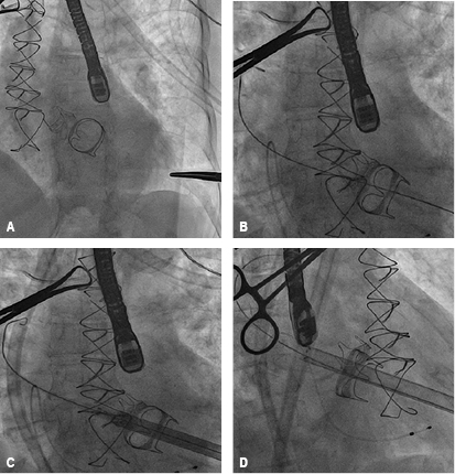 Transcatheter transapical mitral valve-in-valve implantation: case report