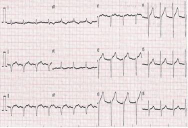 Cardiac senile amyloidosis: a review