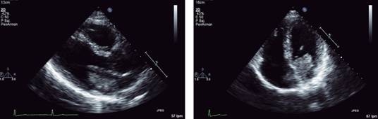 Atrial myxoma in a patient with patent foramen ovale: evaluation with ...