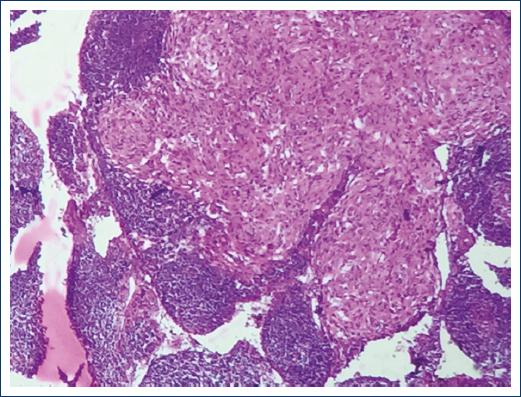 Gastrointestinal stromal tumor: pathological and clinical ...