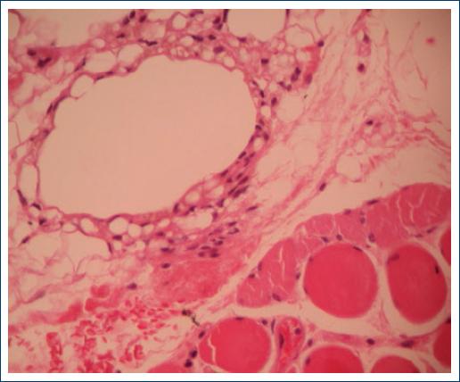 Silicone Oil Filler Induced Granuloma Siliconoma Presenting As Acute Dacryocystitis 