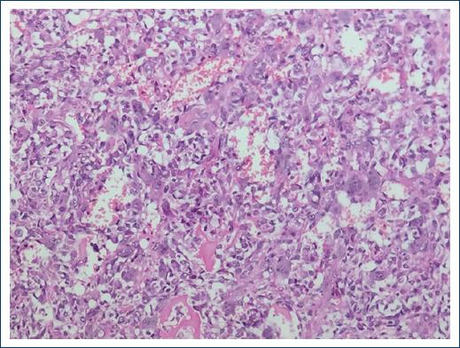 Maxillary osteosarcoma: Morphological variants, clinicopathological ...