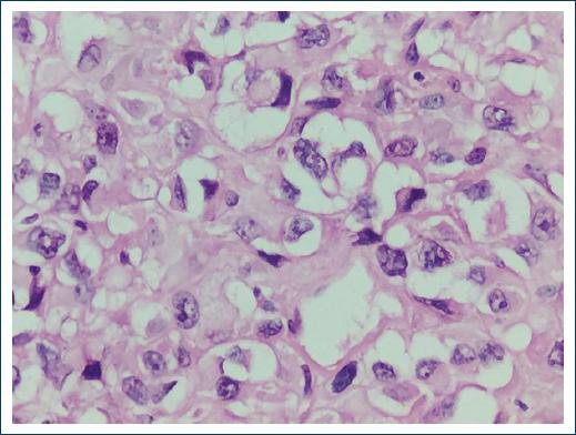 Maxillary osteosarcoma: Morphological variants, clinicopathological ...