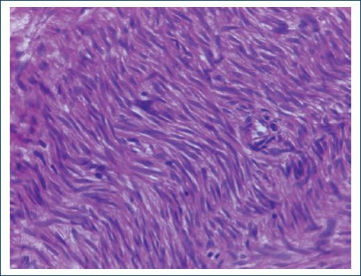 Disseminated peritoneal leiomyomatosis. A rare disease with a difficult ...