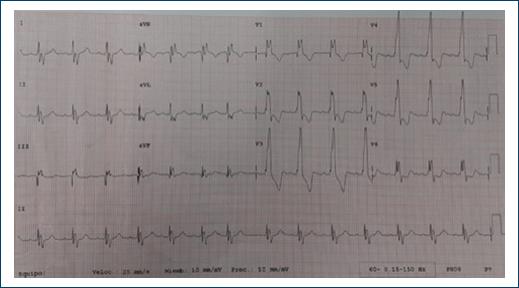 Percutaneous balloon valvuloplasty in a pregnant patient with pulmonary ...