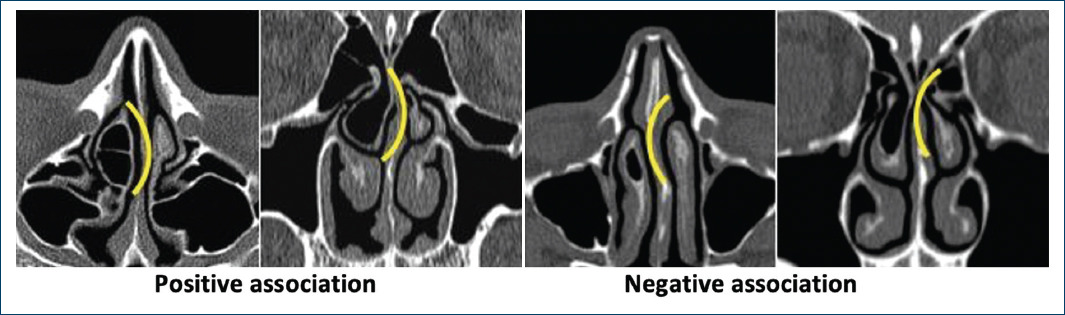 Concha bullosa and nasal septum by tomographic study; experience at the ...