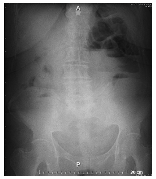 Biliary ileus an uncommon cause of intestinal occlusion: case report