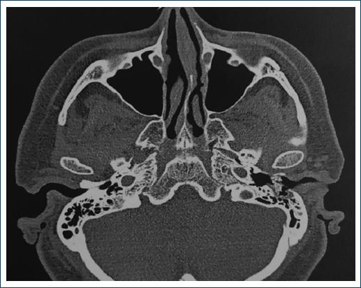 Aspergillus otomastoiditis: a case report and review of the literature