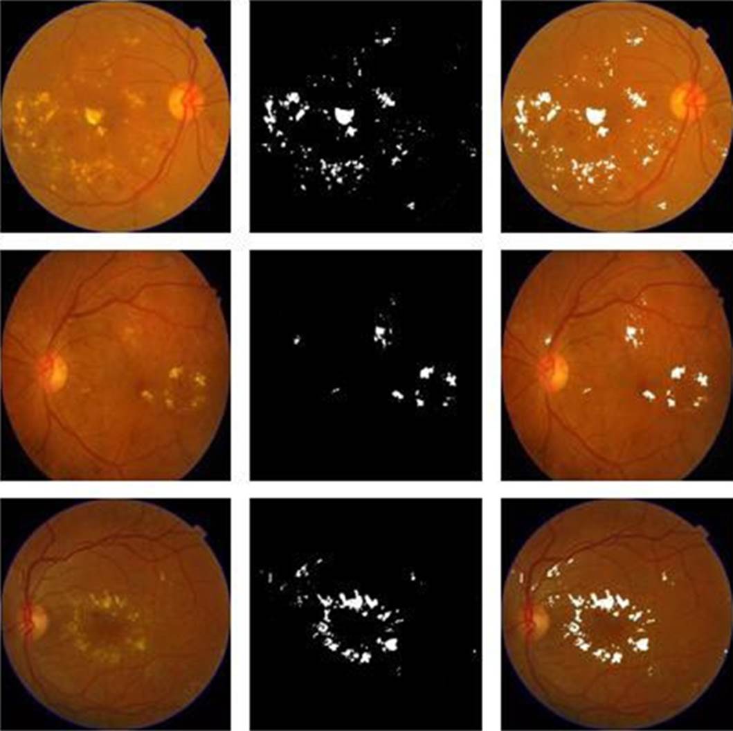 Detection of Exudates and Microaneurysms in the Retina by Segmentation ...