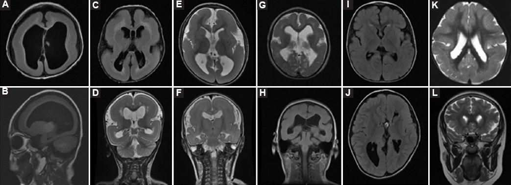 Lissencephaly: Clinical and neuroimaging features in children