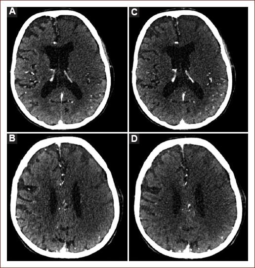 Correlation between dual-phase CTA-SI ASPECTS and automated CT ...