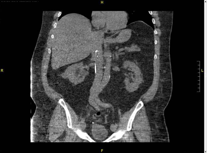 Multidisciplinary Approach For Ureteral Stent Intravascular Migration ...