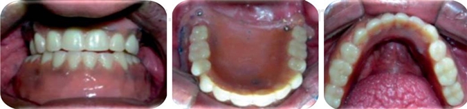 
							Placement of dentures in the patient.
						