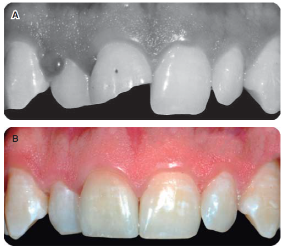 Tratamiento Restaurador De Lesiones Dentales Traumáticas. Reporte De ...